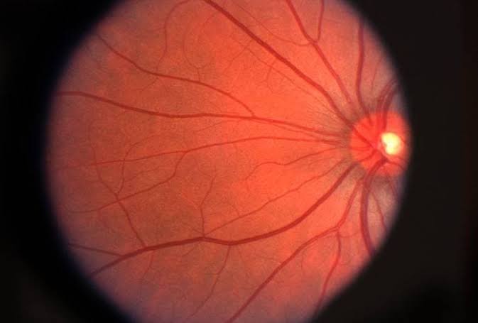 Retinal Disorders