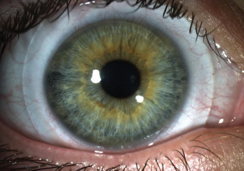 Scleral Lenses